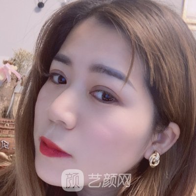 杭州连天美医疗美容医院割双眼皮怎么样?2023实例公开