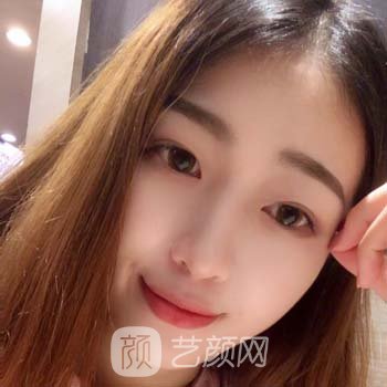 郑州美莱周蔚隆鼻实例，好看的鼻子让我颜值加倍