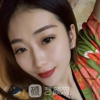 郑州美莱周蔚隆鼻实例，好看的鼻子让我颜值加倍