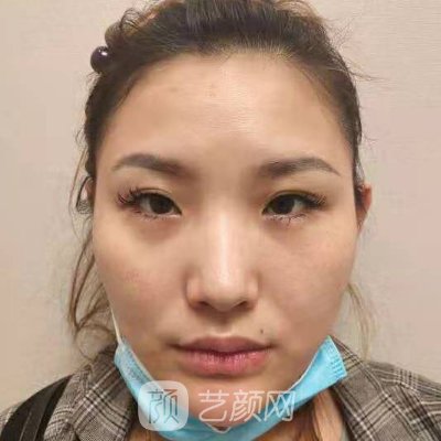 济南美莲韩旭医生割双眼皮怎么样?全新体验实例分享