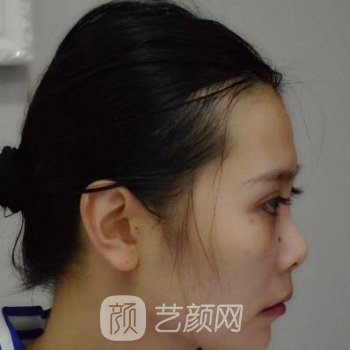 王志鹏做鼻子怎么样？多少钱？医生简介+隆鼻实例对比图