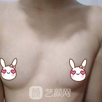 广州郝永生隆胸实例，拥有了饱满立体的胸部，变得特别有女人味