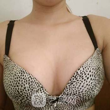 广州郝永生隆胸实例，拥有了饱满立体的胸部，变得特别有女人味