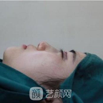 康深松隆鼻实例，医生果然没有让我失望，海鸥线好美