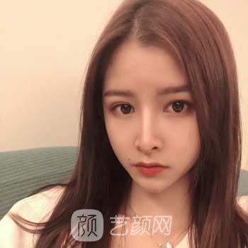 李劲良隆鼻整形实例，身边的朋友都夸我变得好看了，越来越自信了