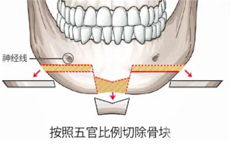 面部整形包含了哪些项目？