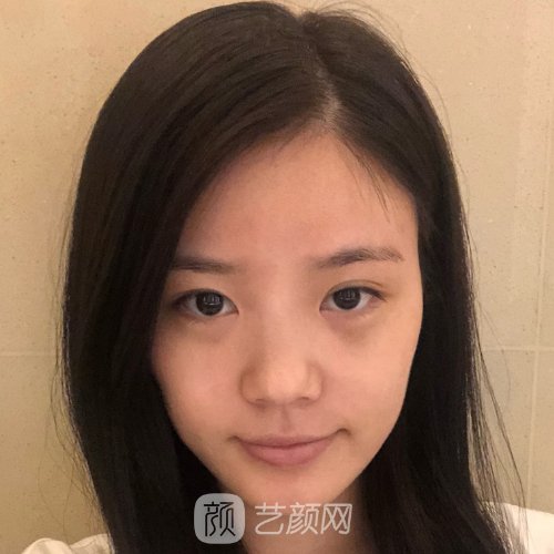 西南医院黄书鹏鼻综合实例分享|附亲身体验成果图