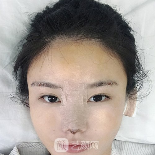 西南医院黄书鹏鼻综合实例分享|附亲身体验成果图