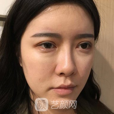 北京首玺丽格全新隆鼻实例曝光|成果自然无痕