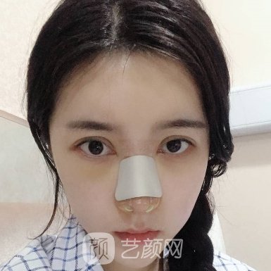 北京首玺丽格全新隆鼻实例曝光|成果自然无痕