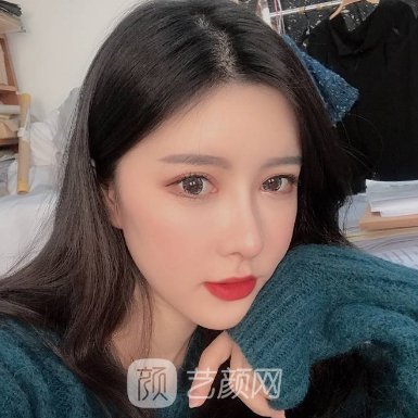 北京首玺丽格全新隆鼻实例曝光|成果自然无痕