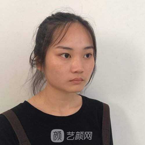 聊城市人民医院植发实例分享|成果自然美观