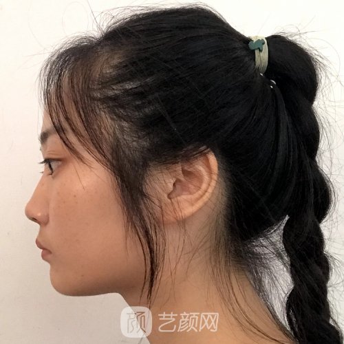 聊城市人民医院植发实例分享|成果自然美观