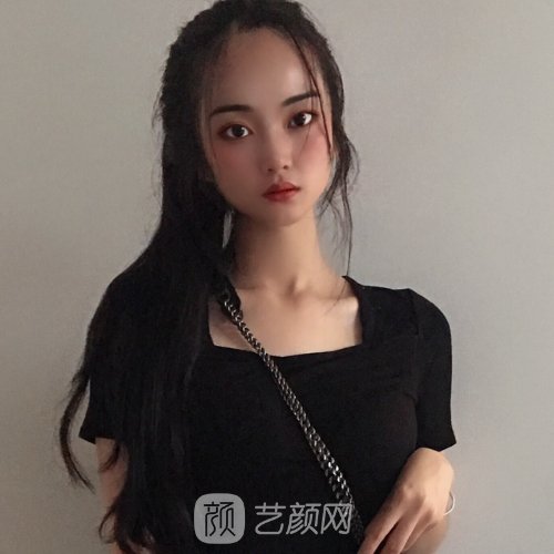 聊城市人民医院植发实例分享|成果自然美观