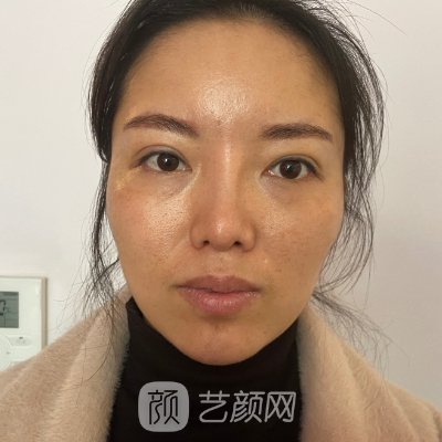 杏林沈阳张莹莹面部脂肪填充实例展示|附体验成果图