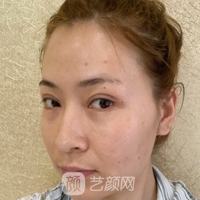 深圳美莱熊苏民医生玻尿酸注射除皱实例一览|内附成果图