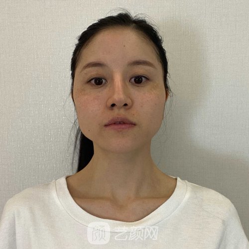 上海美联臣曹栋弼下颌角整形实例曝光|内附体验细节图