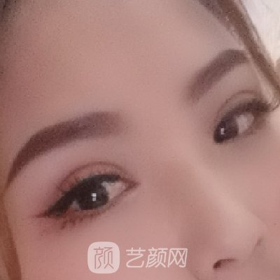 北京画美刘风卓医生割双眼皮怎么样?90天修复实例公开