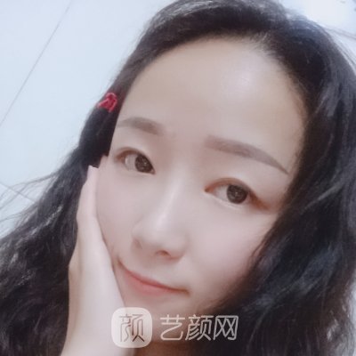 昆明梦想整形美容医院口碑怎么样？2023双眼皮整形实例出炉