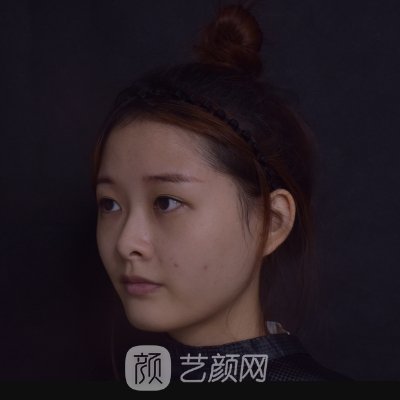 广州美莱整形医院隆鼻实例展示|体验成果自然无痕