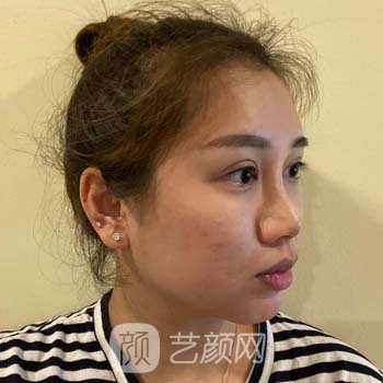 李劲良隆鼻野生实例，化妆再也不用打高光了，美丽动人