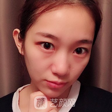 长沙一雅医疗美容医院正规吗?2023隆鼻实例分享