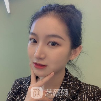 长沙一雅医疗美容医院正规吗?2023隆鼻实例分享