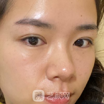 杭州鹏爱医疗整形医院割双眼皮怎么样?2023实例公开