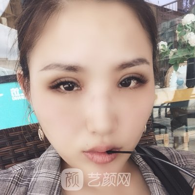 贵州省人民医院整形科双眼皮整形实例出炉|成果自然美观
