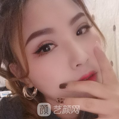 贵州省人民医院整形科双眼皮整形实例出炉|成果自然美观