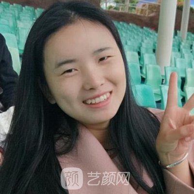 福州美贝尔叶森明割双眼皮怎么样?2023招牌实例一览