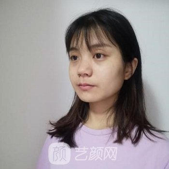 贵阳徐威隆鼻实例，打造美观自然鼻部形态