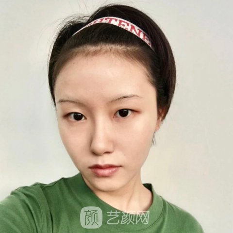 昆明美立方整形医院口碑怎么样?2023注射除皱实例分享