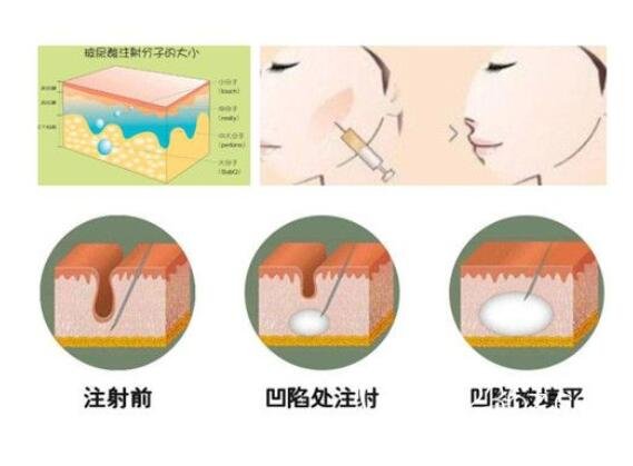 玻尿酸脸部轮廓的雕塑技术,面部线条不好看的宝宝可以来看看
