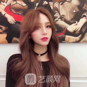 沈阳医大一院黄威隆鼻实例，完全看不出手术痕迹，就像天生的鼻子一样