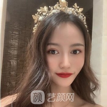 武汉孙家明双眼皮实例，五官立体自然，手术痕迹消失