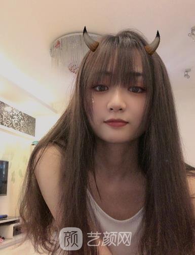吉纹锡磨骨失败修复实例,下颌角的弧度很优美，是想要的成果