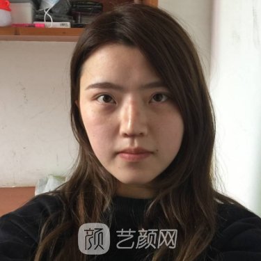 云南华美美莱美容医院正规吗?2023隆鼻实例公开