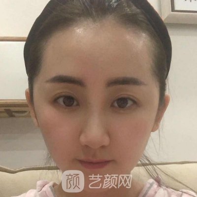 西安施尔绮整形医院正规吗?新版光子嫩肤实例一览