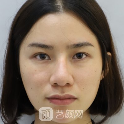 徐州华美隆鼻实例出炉|成果自然无痕