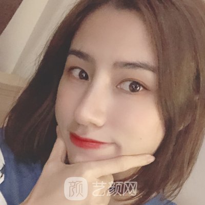 徐州华美隆鼻实例出炉|成果自然无痕