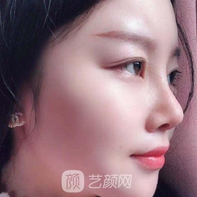 杭州美莱做鼻子怎么样?2023鼻子实例曝光