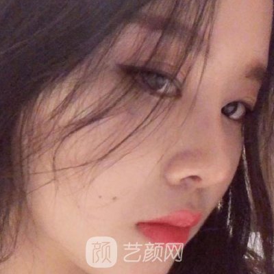 杭州美莱做鼻子怎么样?2023鼻子实例曝光