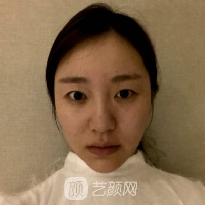 亳州缔莱美整形医院做双眼皮怎么样?2023体验实例出炉