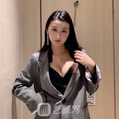 苏州爱思特脂肪隆胸实例展示|附体验成果图