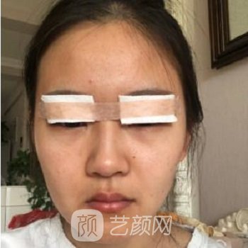 苏州美莱尹飞双眼皮实例，拥有惊艳闺蜜的美丽大眼