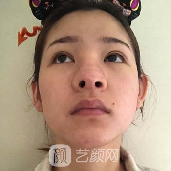 李运峰磨骨实例，左右两边脸型对称，小V脸拍照特别美观