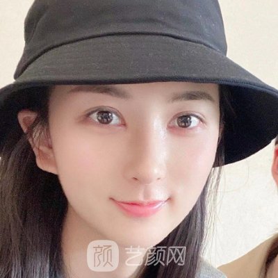 广州美莱田跃平医生做鼻子怎么样？全新体验实例曝光