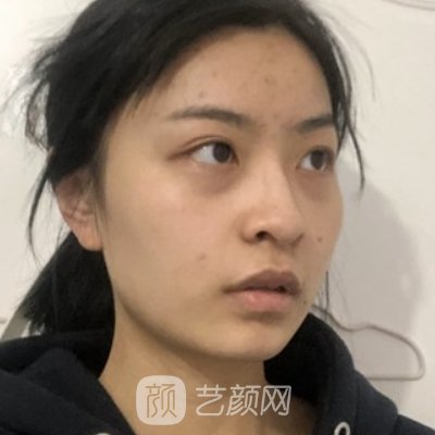 成都蓉雅整形美容医院口碑好吗？全新注射除皱实例分享