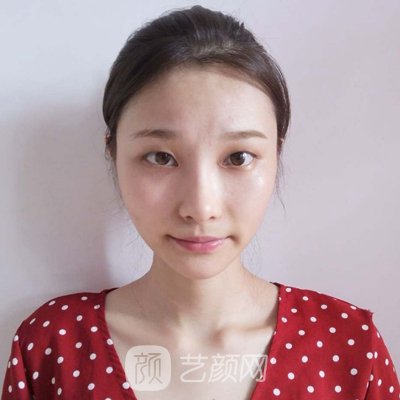 西安俪人整形医院李小莉割双眼皮正规吗？全新体验实例公开